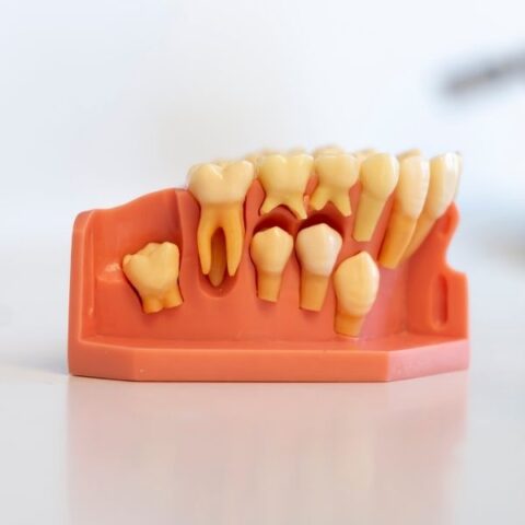 sobredentadura en terrassa